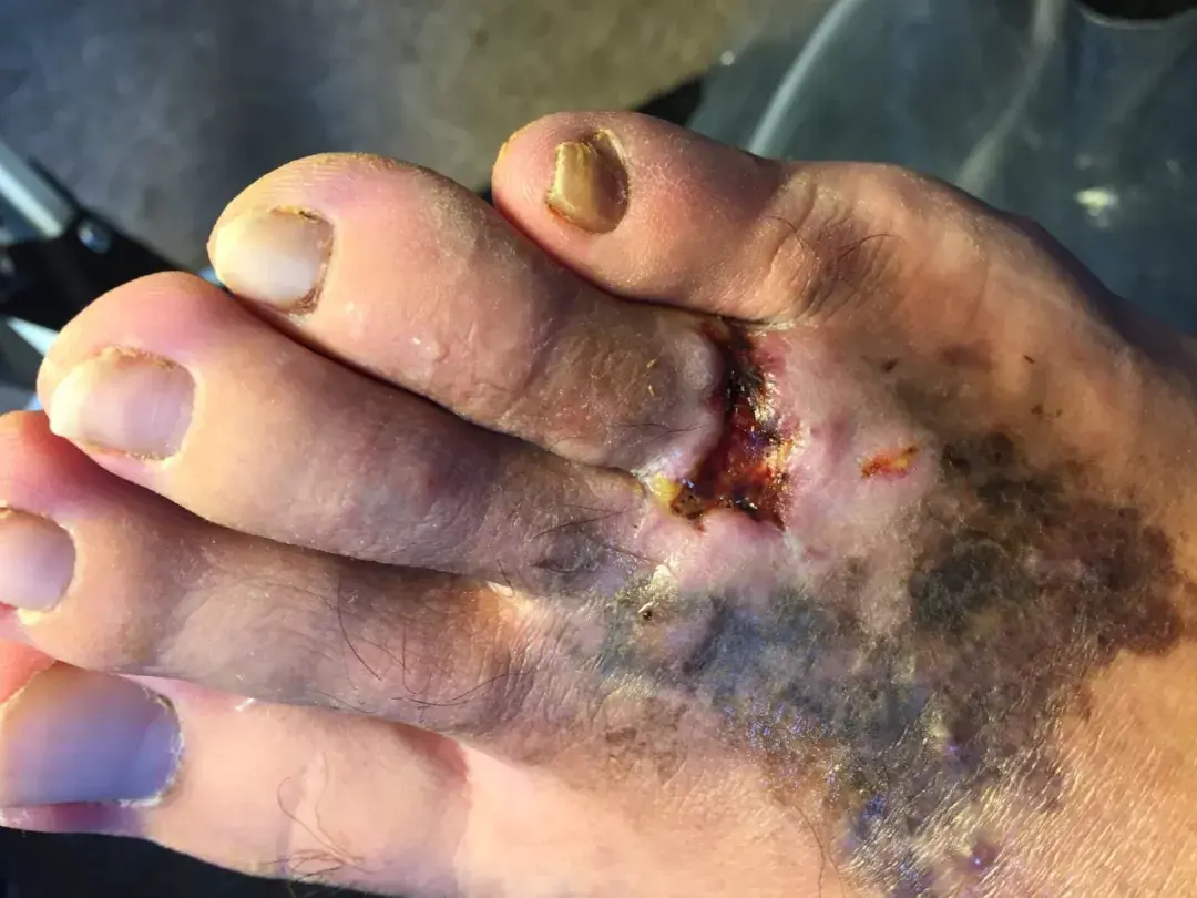 半年后,脚面开始发黑,脚趾末端开始溃烂.