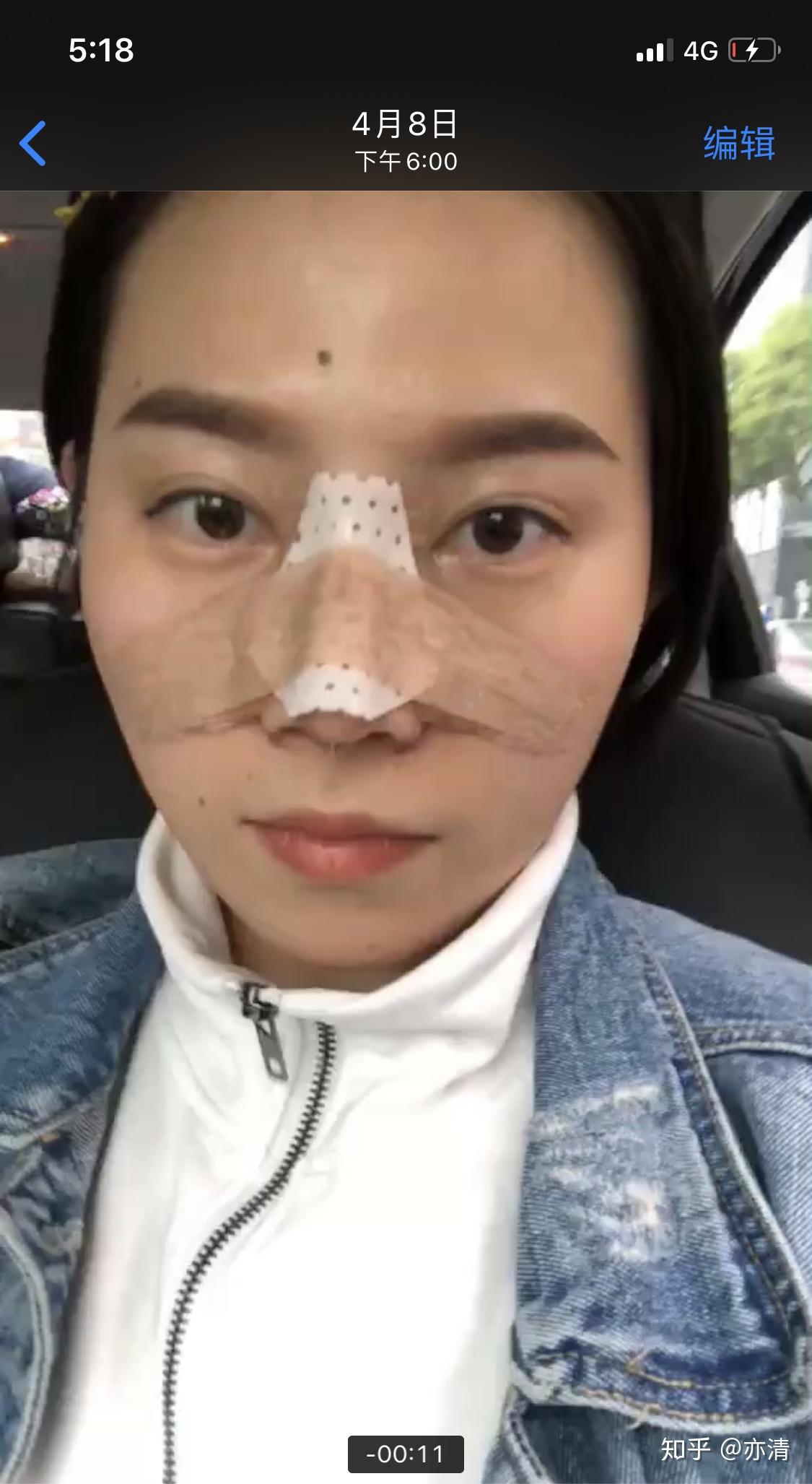 做鼻综合体验 - 知乎