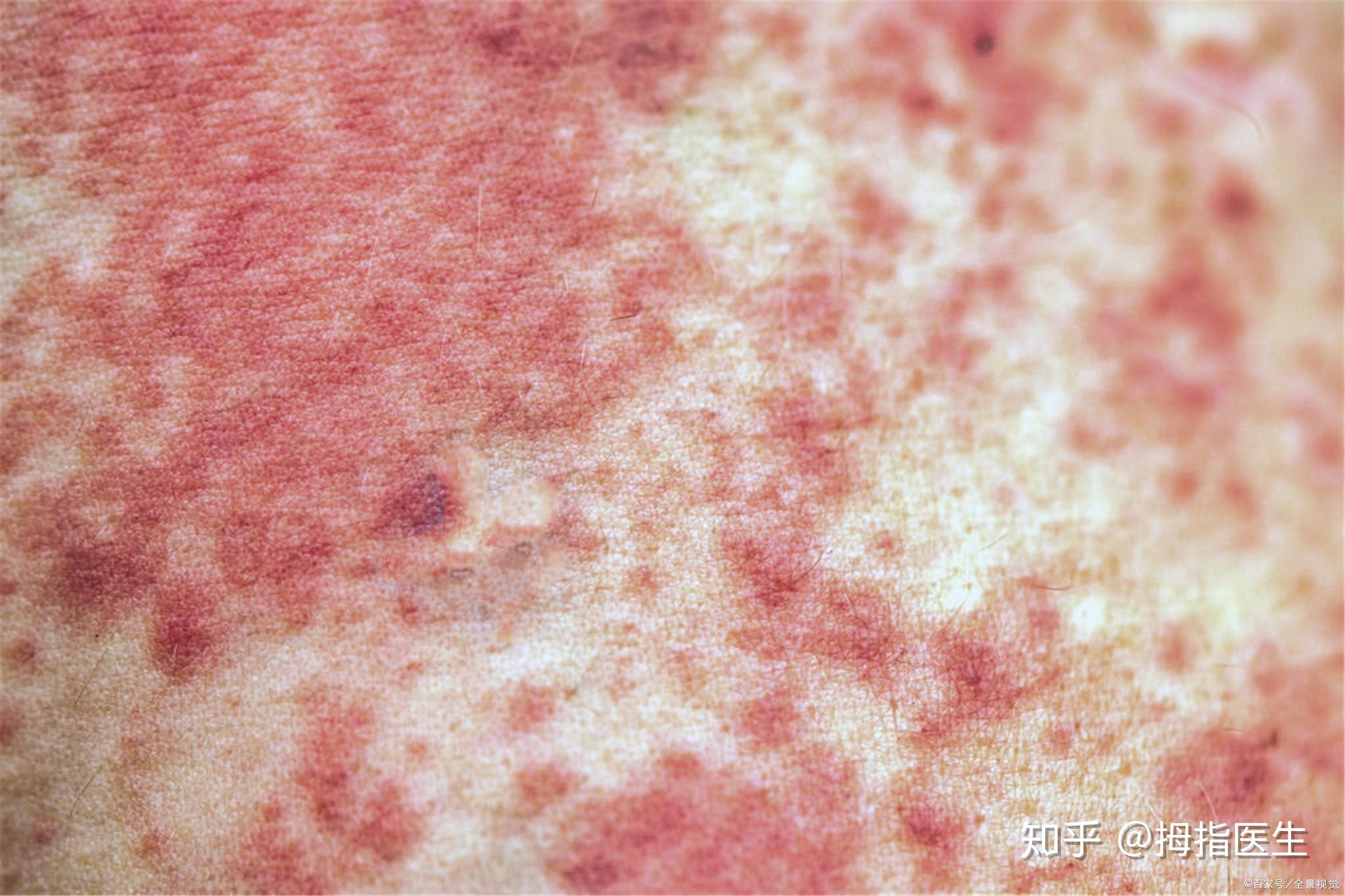 过敏季节，医生教您辨别荨麻疹和湿疹_澎湃号·湃客_澎湃新闻-The Paper