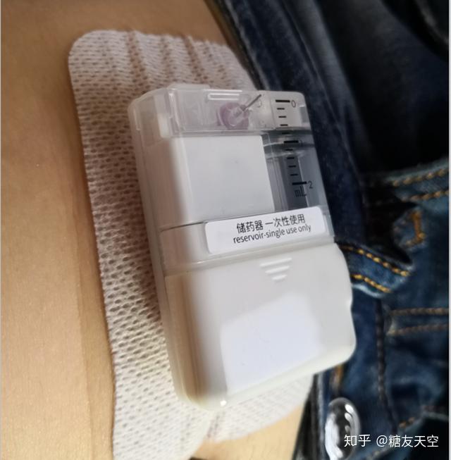 胰岛素泵有哪些类型有什么优缺点