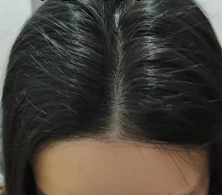 女生发量少头顶快秃了有没有什么好的生发方法