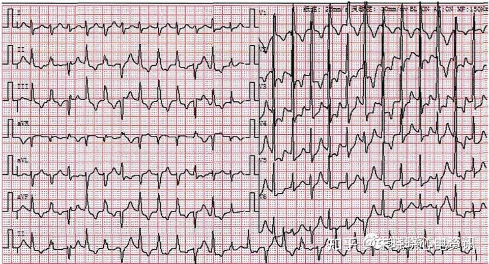 心电危急值之快速性心律失常