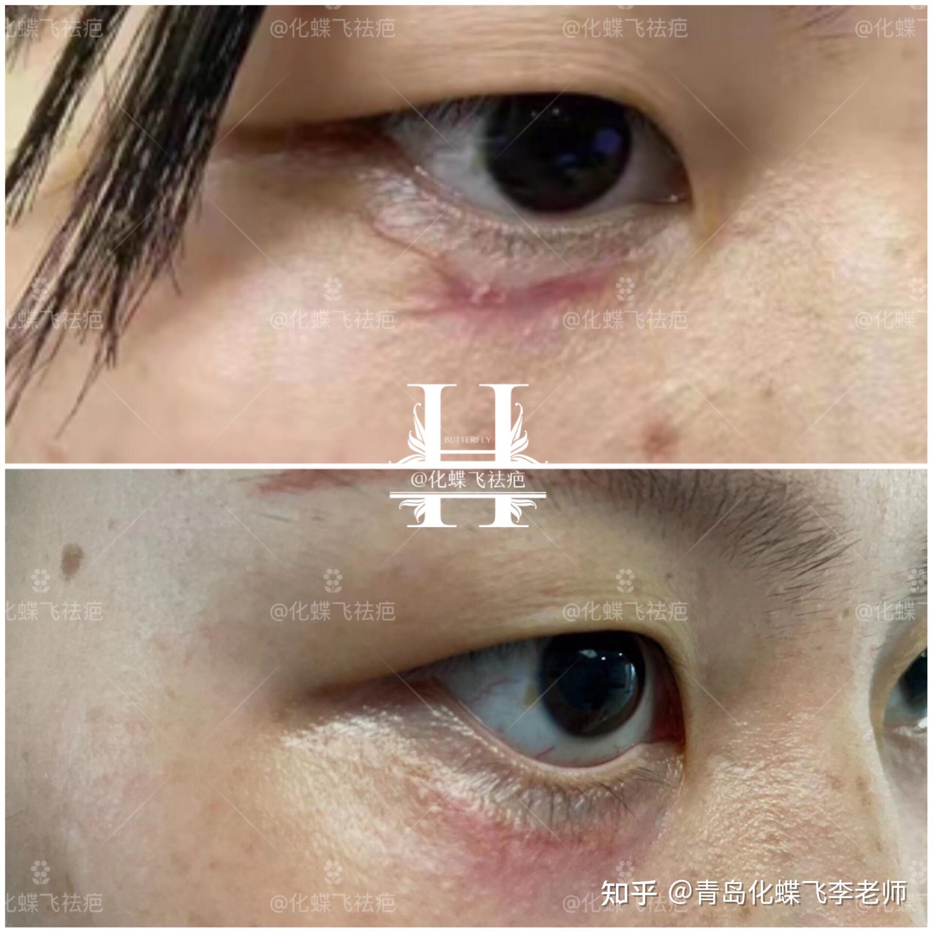 浙江杭州,一场意外的伤害来得那么猝不及防,眼睛下面的疤痕,让美女