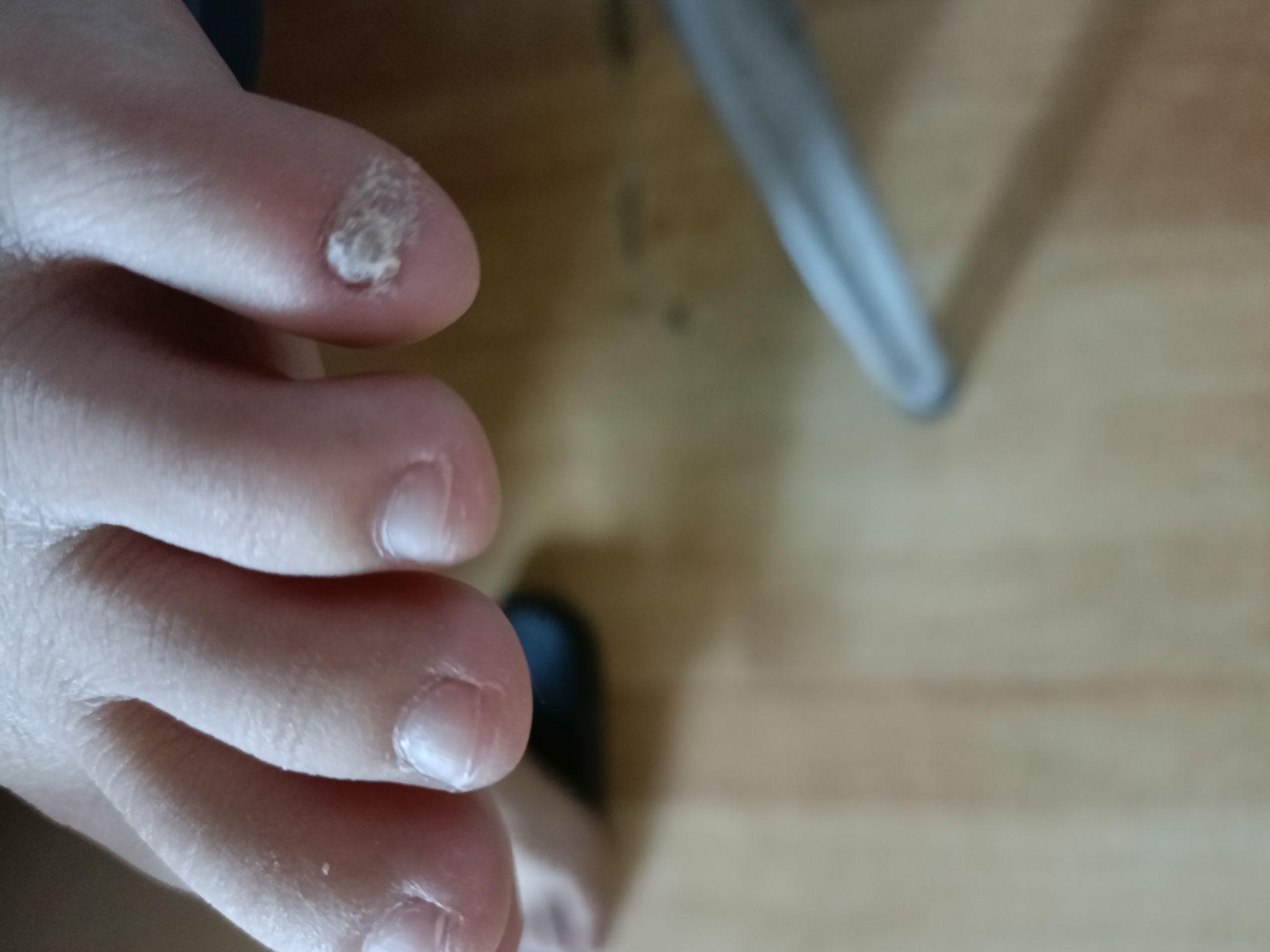 小脚趾的指甲特别难看怎么办