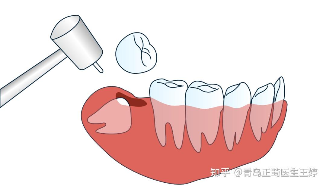 為什麼拔智齒這麼貴難道被坑了