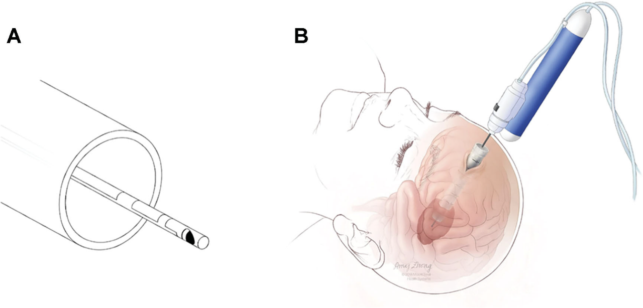 endoport引导血肿清除术.a.插入脑内直径13.