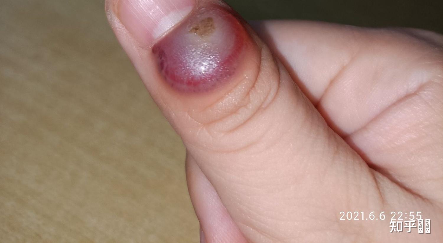 液氮冷冻治疗后手指上出了血泡而且越来越大该怎么办? - 知乎