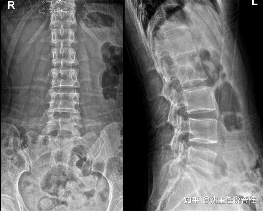 影像检查:腰椎小关节不稳;骨盆未见明显关节异常结合李
