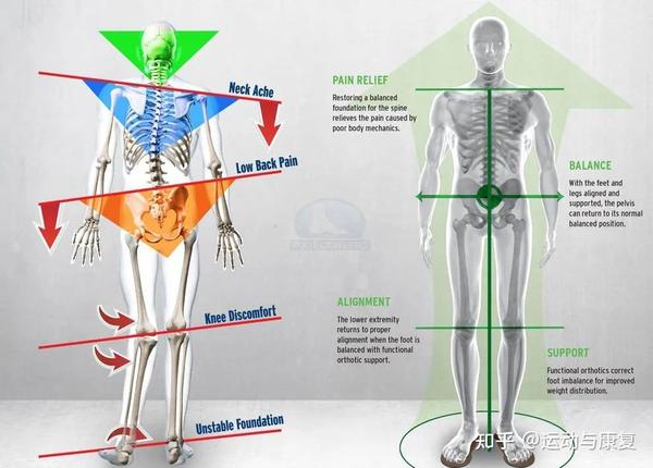 扁平足需要矫正吗？ 知乎