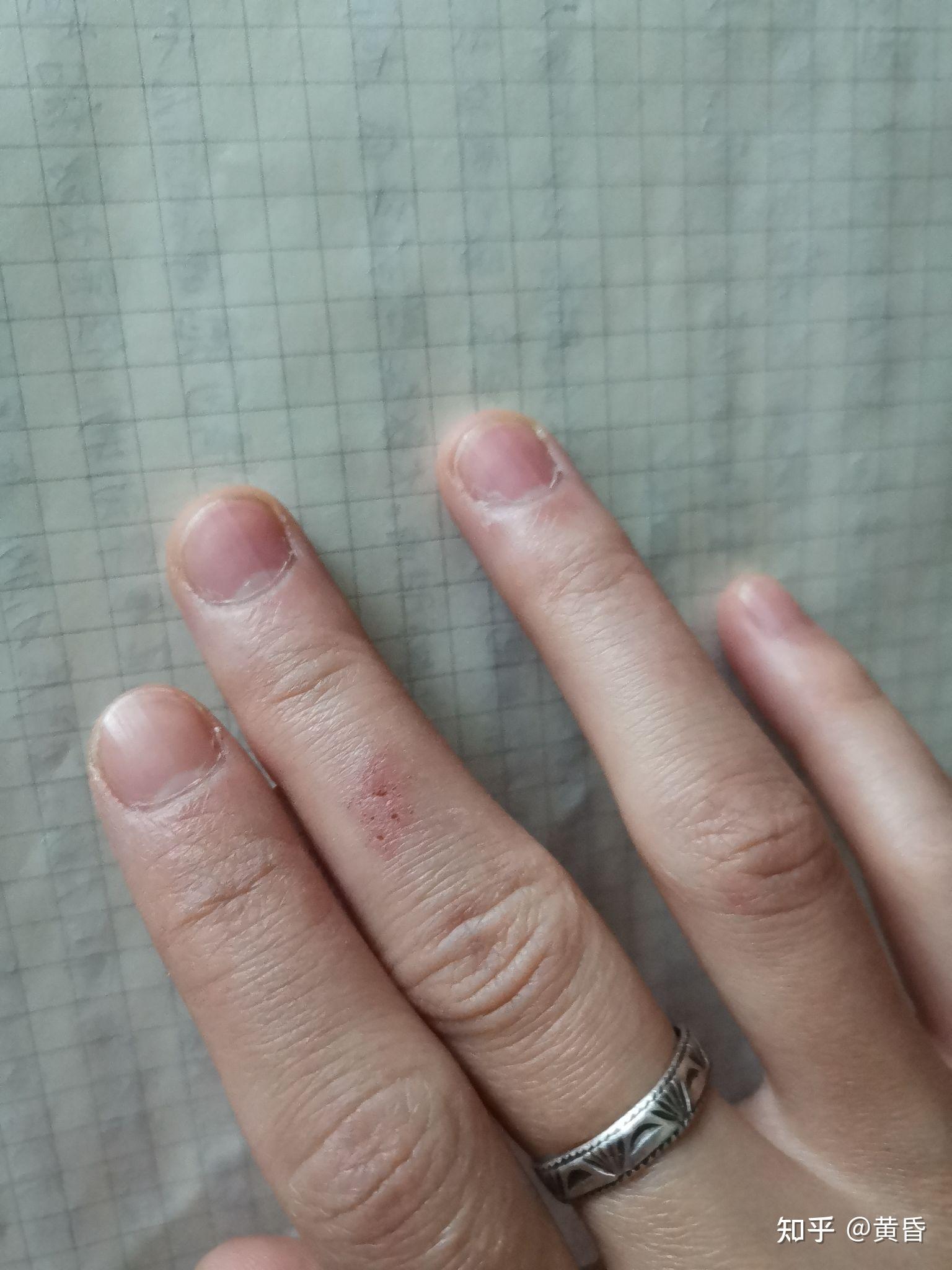 有没有被洗衣粉伤手的经历? - 知乎