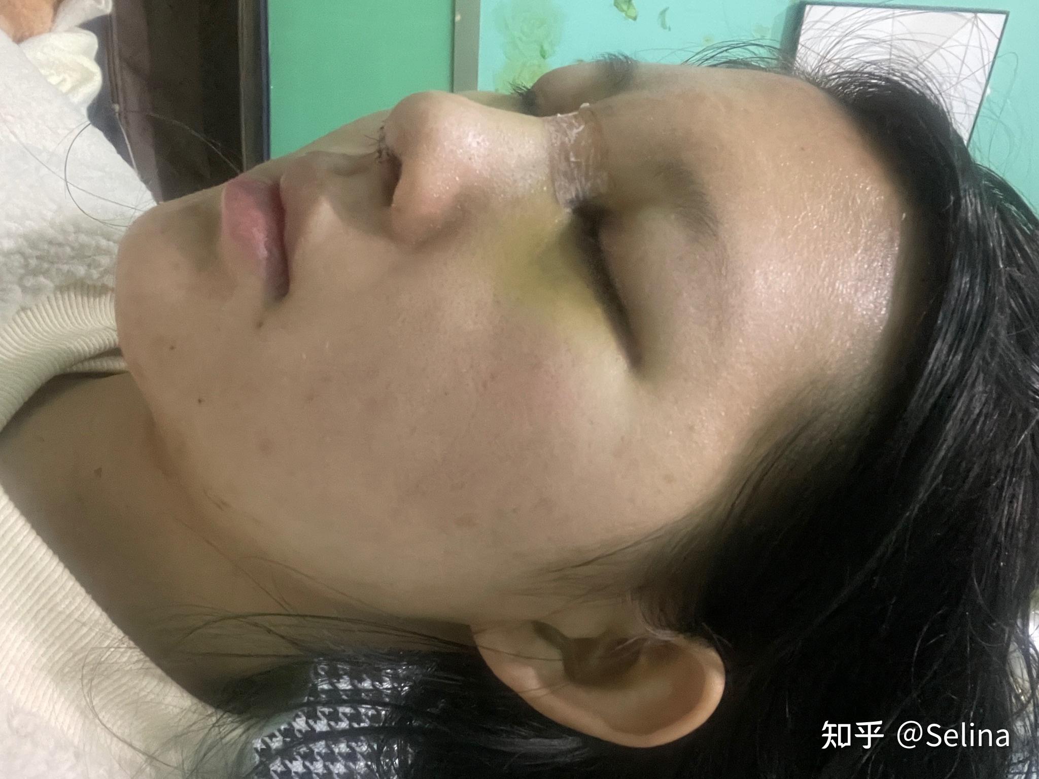 初次隆鼻翻车变成朝天鼻到底为什么