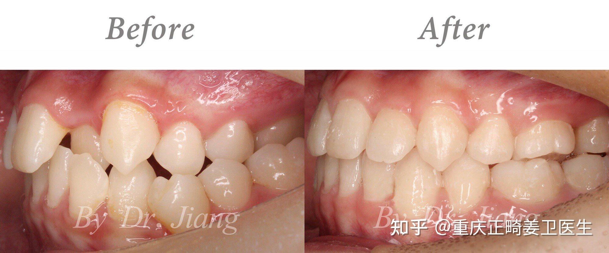 重庆牙齿矫正案例│上颌严重狭窄 牙列不齐且拥挤 不