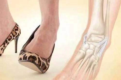 急停等运动项目(跑步,足球,篮球,体操,滑雪等),穿高跟鞋女性,本身关节