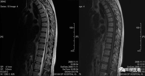 how-neuropathy-is-classified-neuropathy-and-hiv