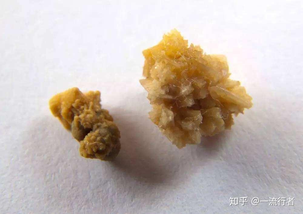 肾结石老是反复怎么办这个关键因素要重视