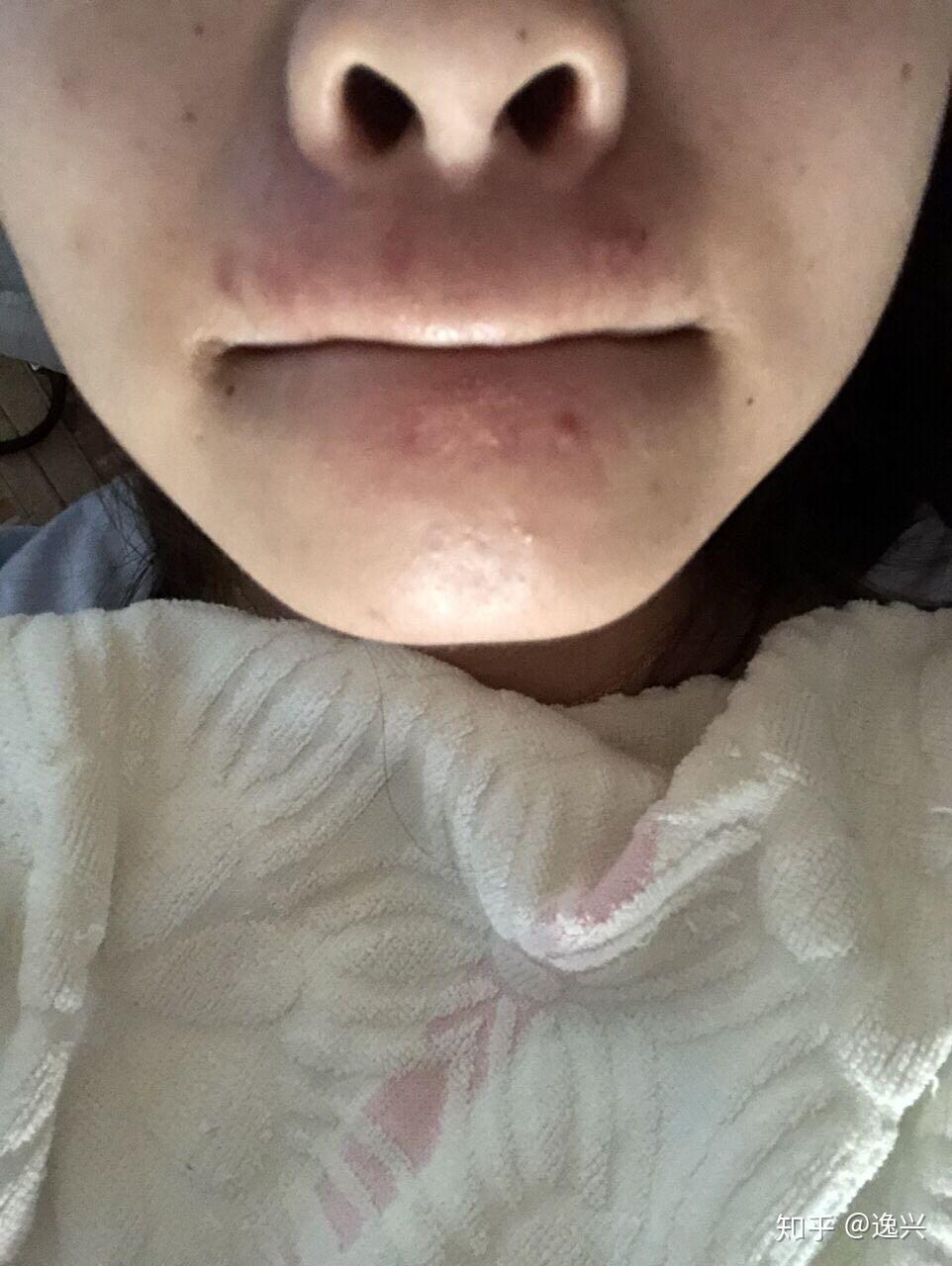 唇周不停长痘怎么办