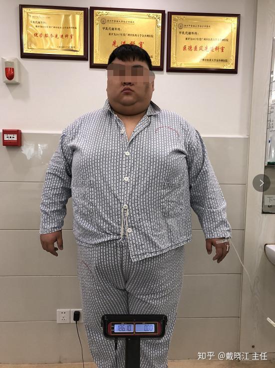 减肥训练营瘦得快372斤小伙却陷入复胖怪圈靠减重手术减肥