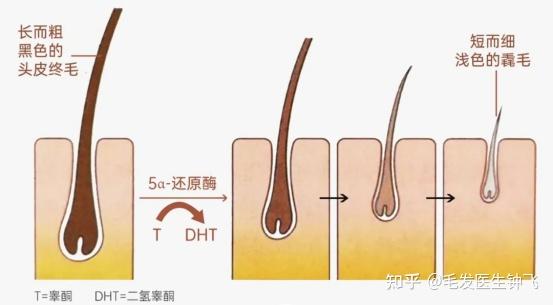 而雙氫睪酮(dht)是越來越多的,就會逐漸出現毛囊萎縮的情況,頭髮也