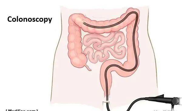 为什么说胃肠镜是救命的检查90的疾病都集中在消化道