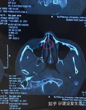 打篮球鼻骨 鼻中隔骨折是什么体验 知乎