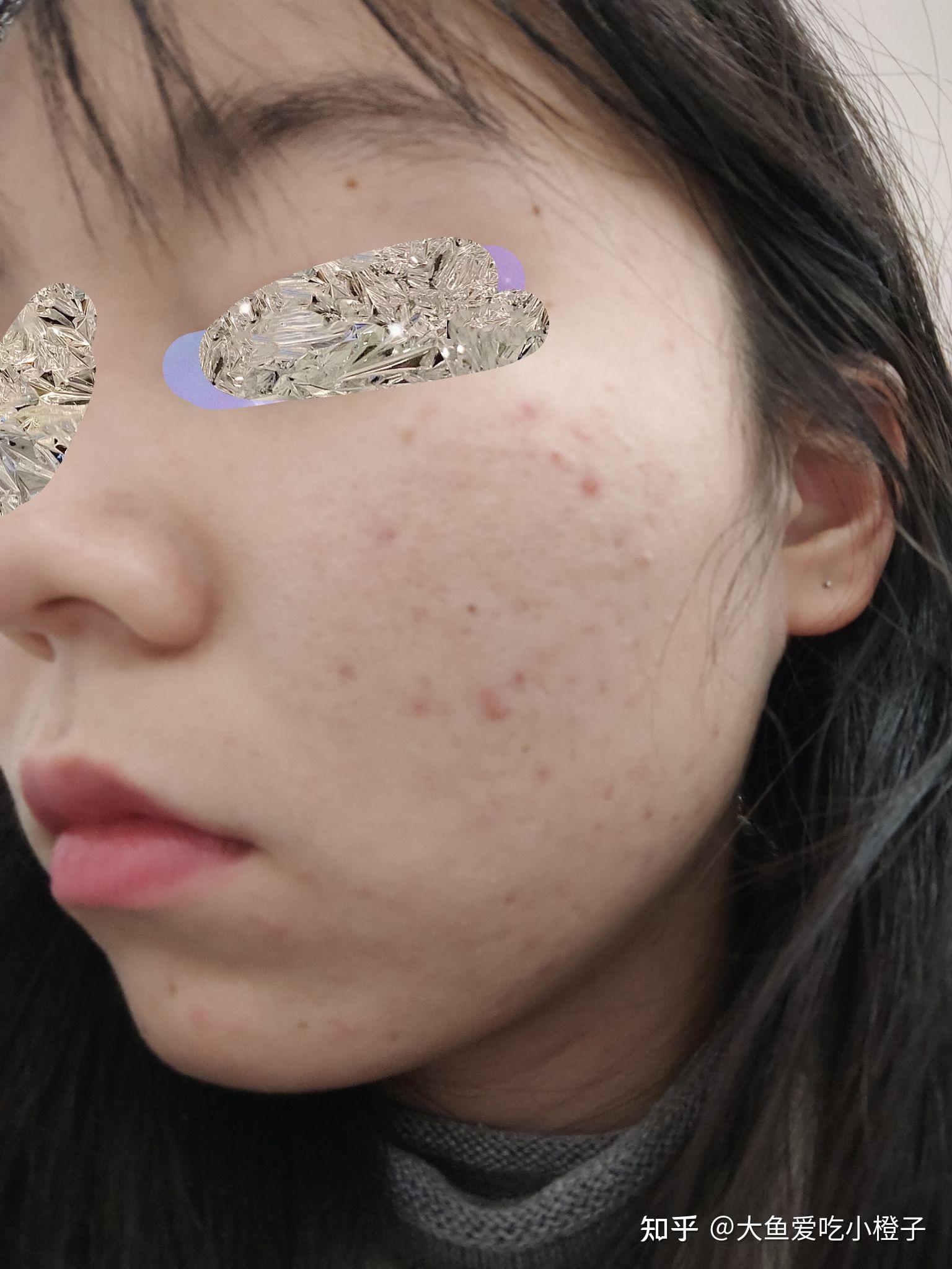 祛痘(阿达帕林凝胶,复方木尼孜其颗粒,维生素b6片)!