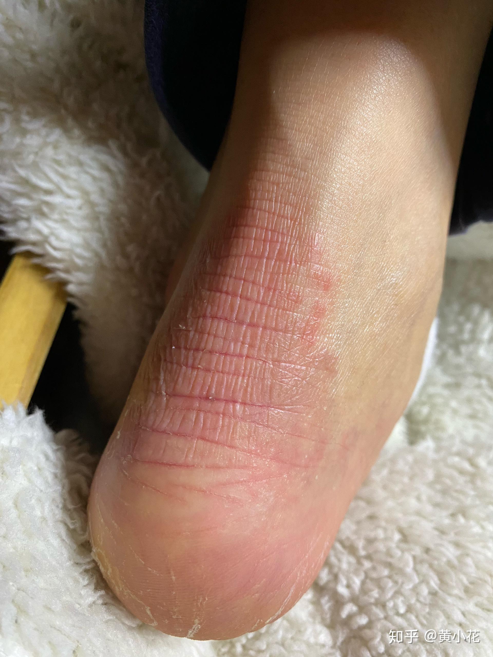 脚踝处长一片红点? - 知乎