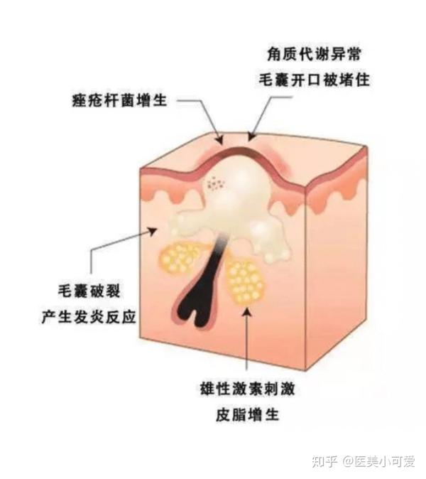 痘痘類型成因處理小總結