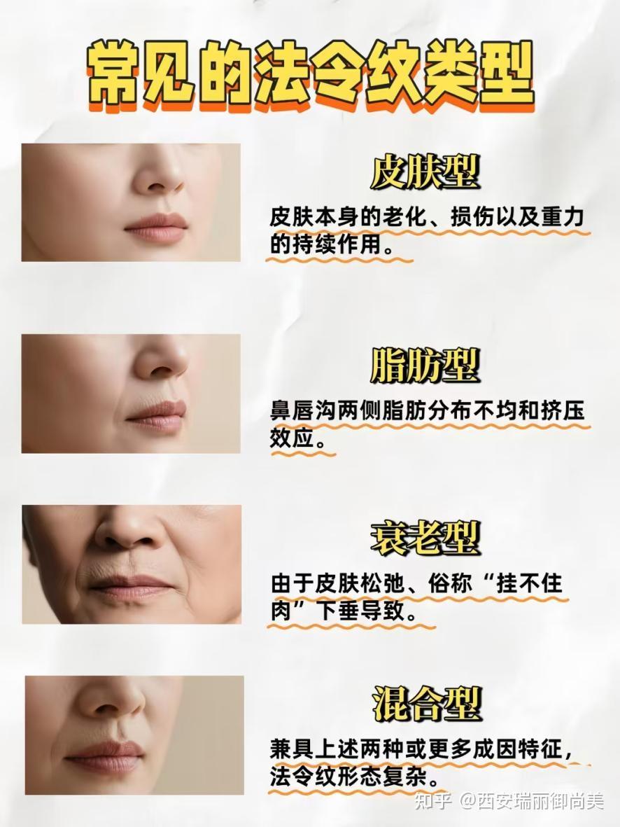 常见类型| 法令纹的四大类型 - 知乎