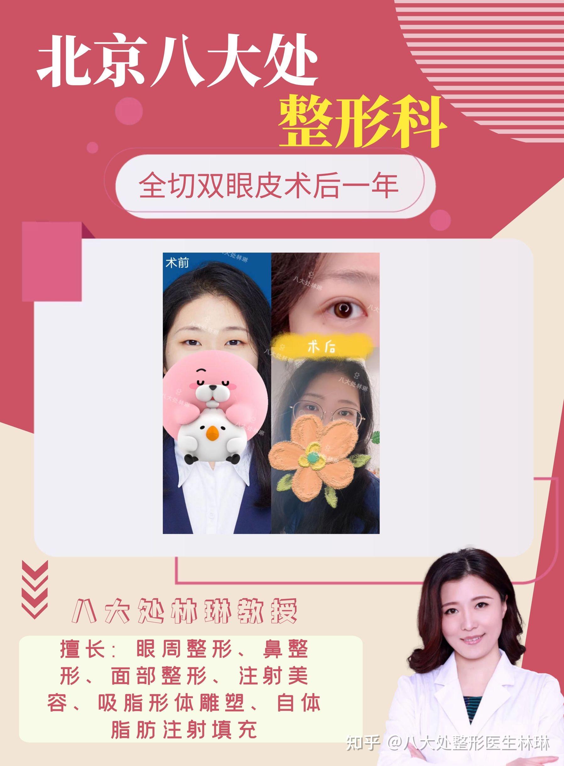 北京林琳双眼皮术后一年反馈