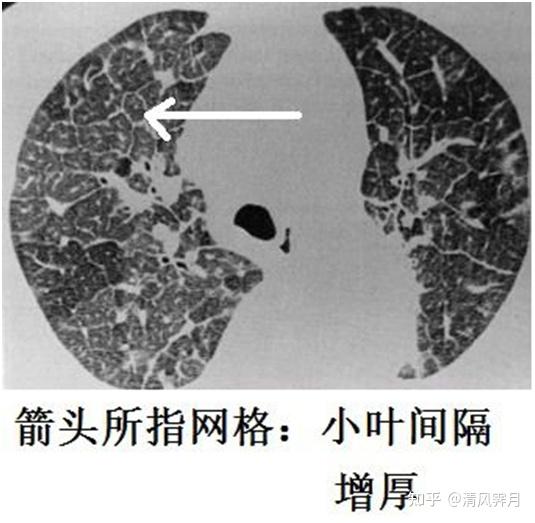 肺水肿影像