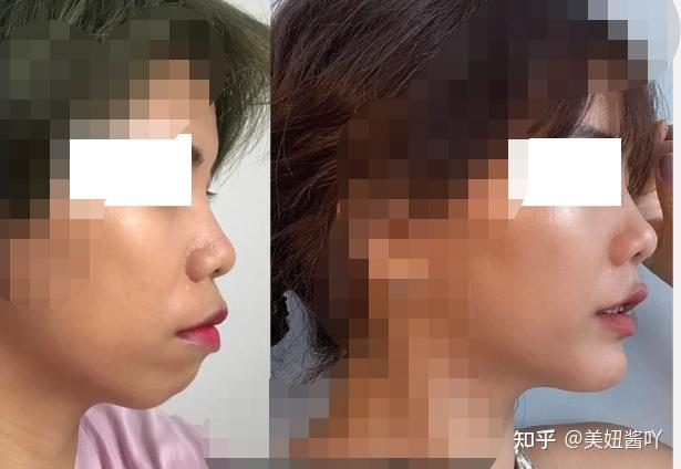 做正颌手术有哪些风险想做正颌之前先看看这篇