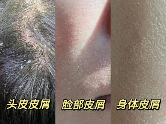 【冬天全身去皮屑攻略】头皮屑多/脸干燥起皮/身体皮肤粗糙怎么办?「专业医师」耗时2天整理全身去皮屑+补水保湿的正确方法,皮屑干痒不反复! - 知乎