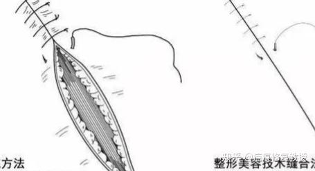 美容缝合究竟是何方神圣？竟能够“雁过不留痕” - 知乎