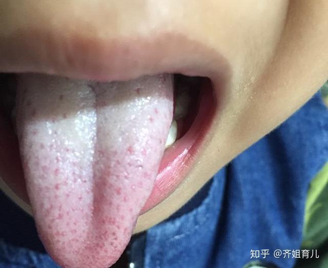 如果脾胃功能失常,比如出现了积食的现象,舌苔就会变得厚重,且粘腻