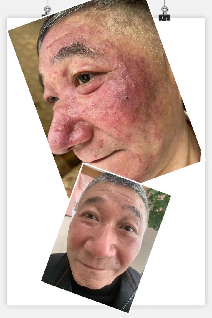 玫瑰痤疮(酒糟鼻)红鼻头