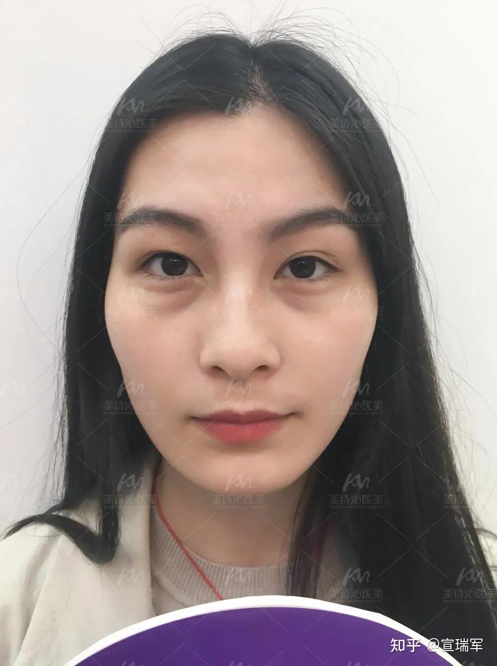 请问脸部左侧法令纹显和左侧眼部眼袋比右眼大左眼有泪沟右眼没有这是