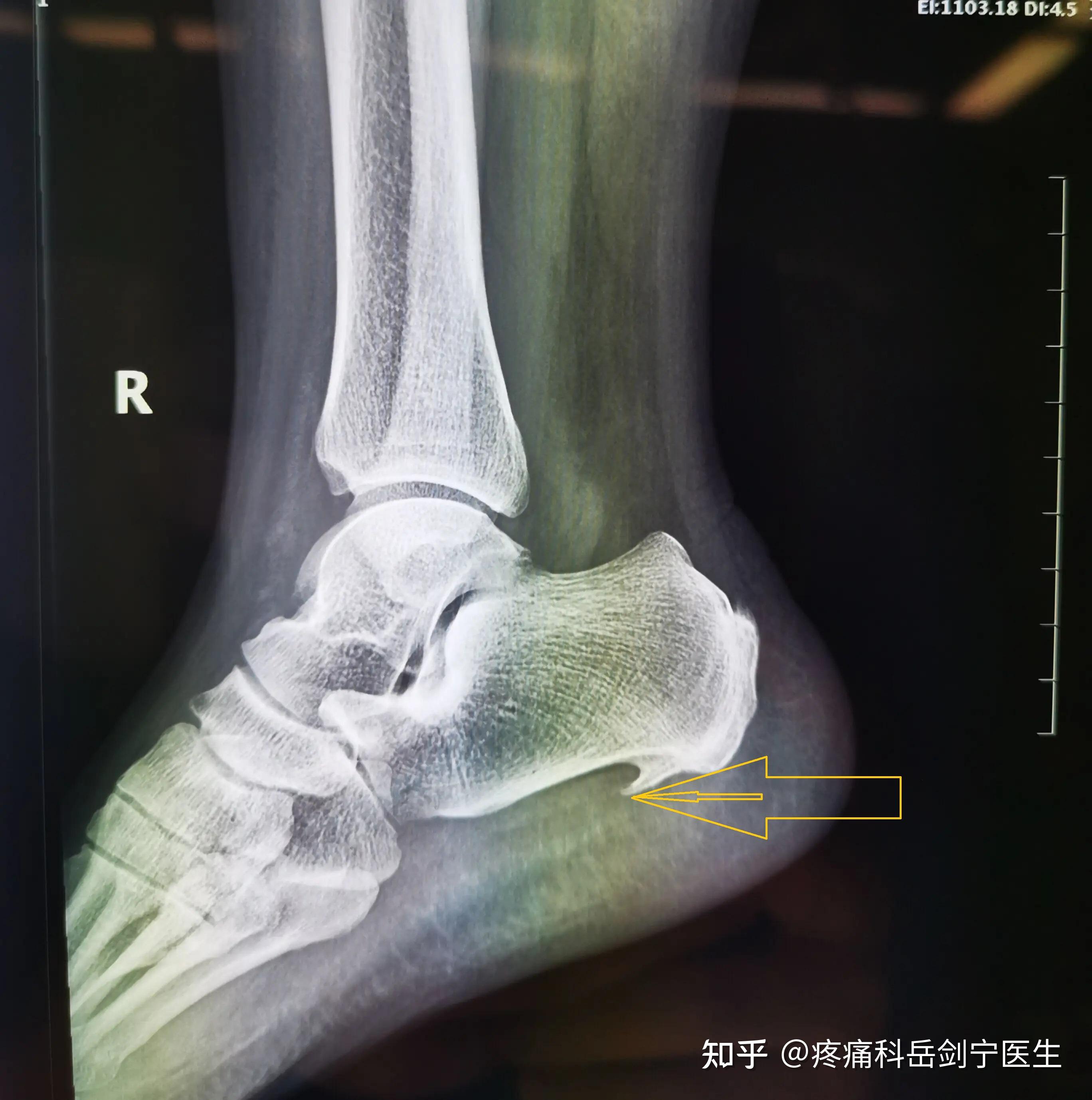 脚后跟疼?怎么治疗? - 知乎