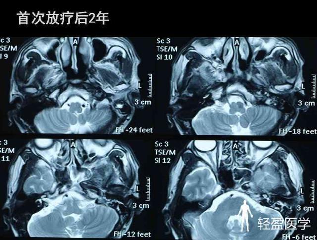 主訴確診鼻咽癌5年餘,左顳葉佔位放療後3年.