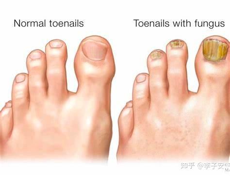 灰指甲与真菌有什么关系?灰指甲真的很难治疗么