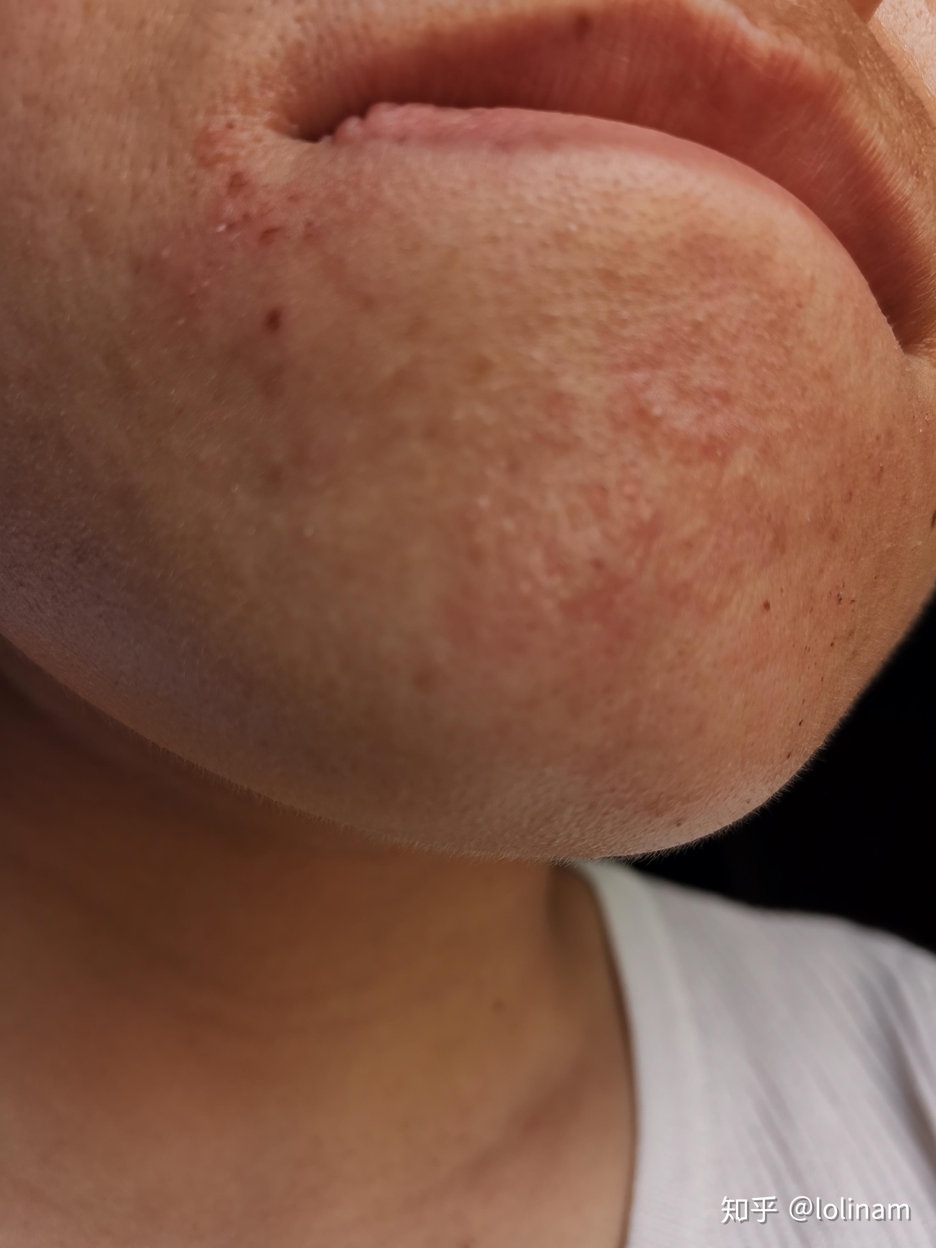 下巴反复长闭口一大排密密麻麻还凸起怎么办