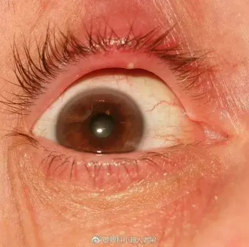 怎么快速治好或者缓解麦粒肿? - 知乎
