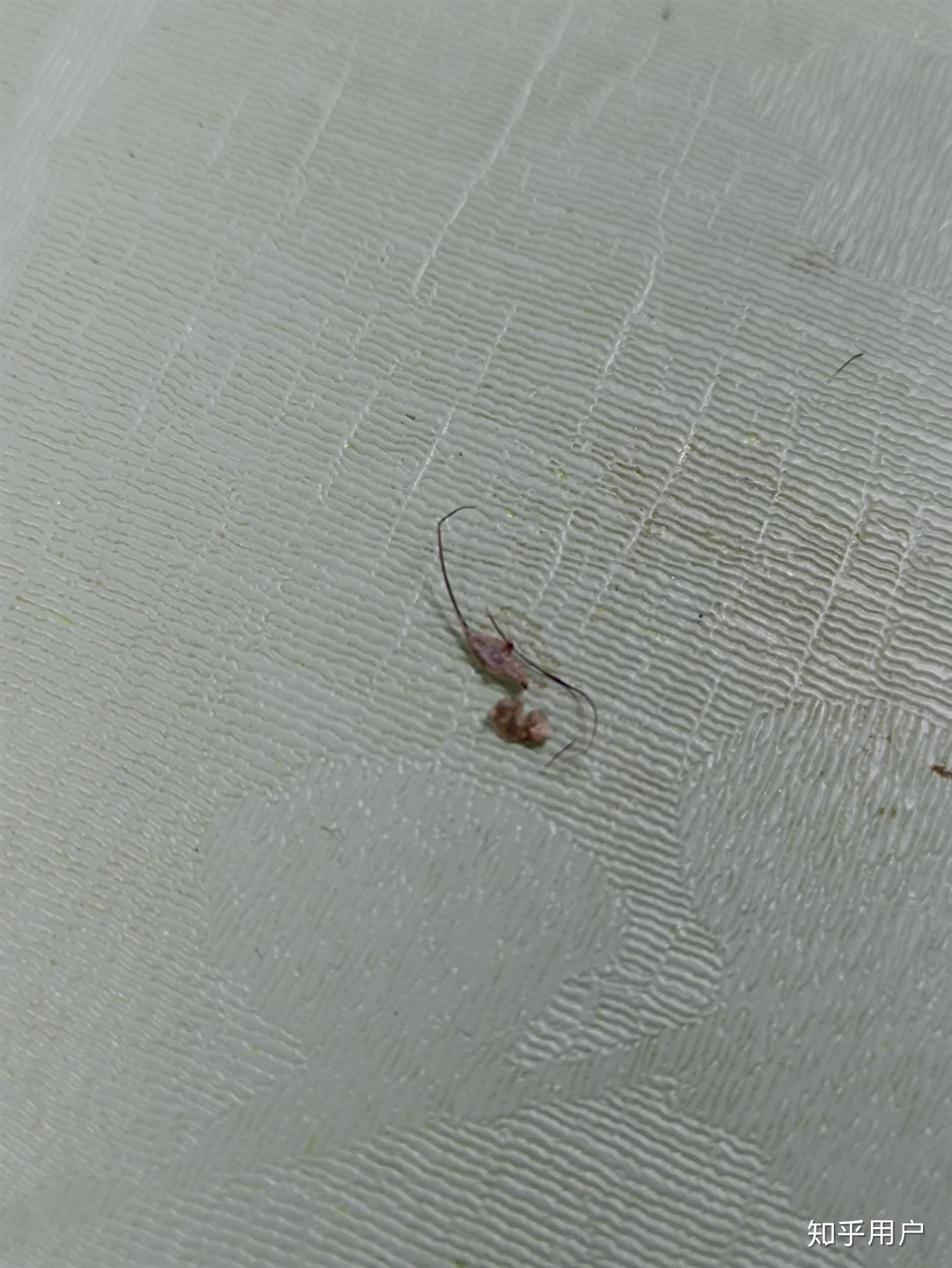 毛发内生该怎么处理? - 知乎