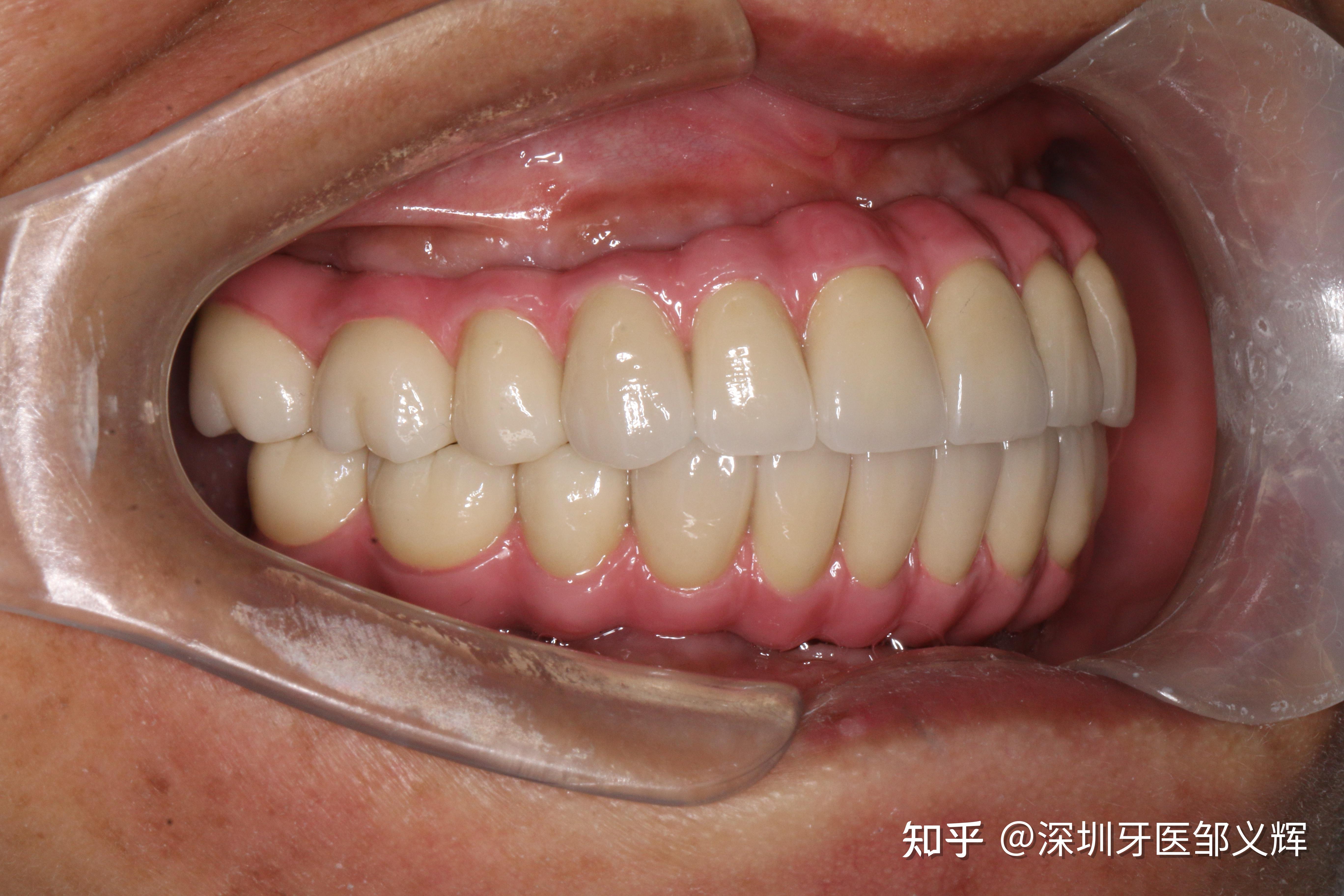 无牙颌修复一例