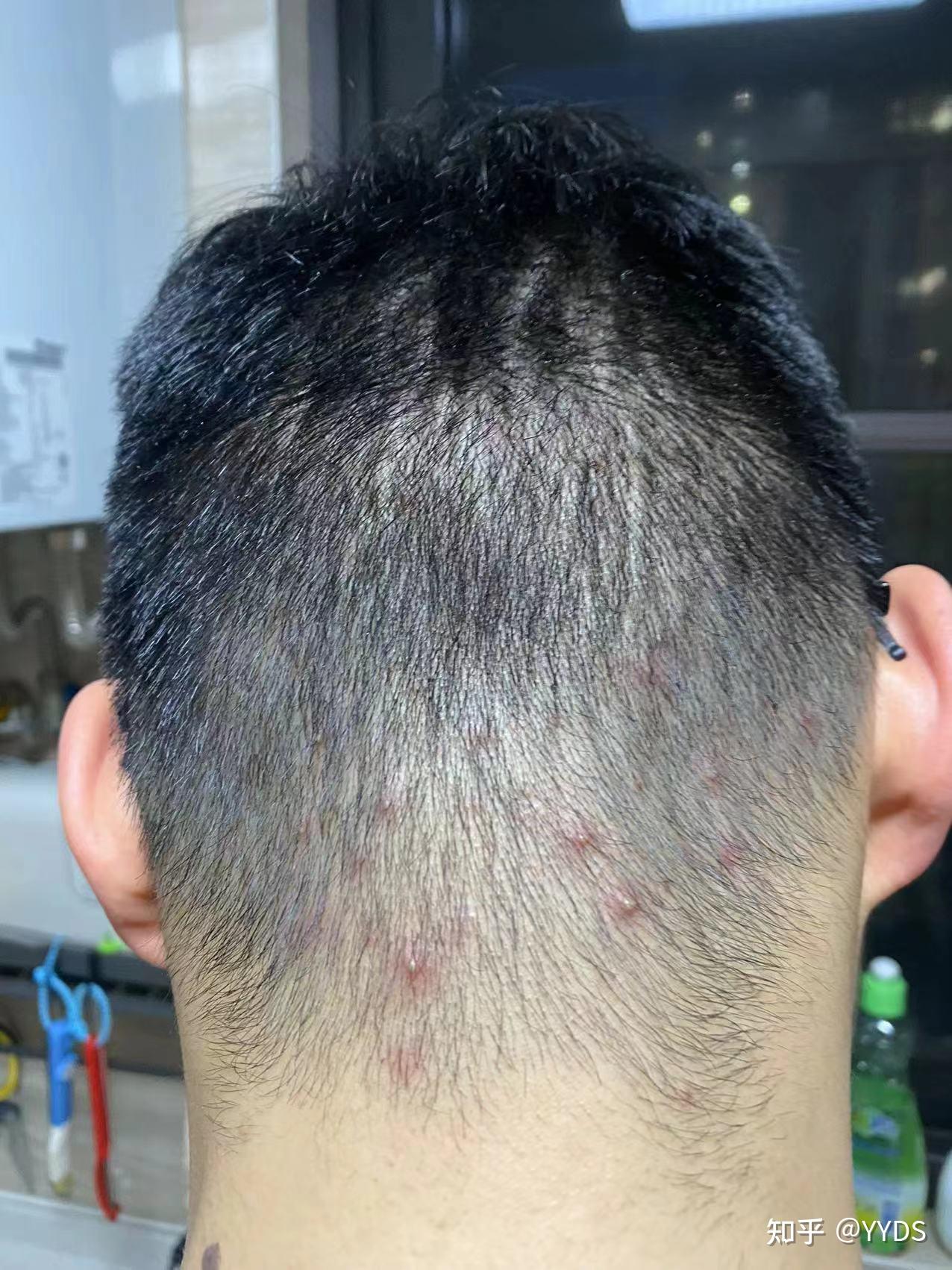 记一次毛囊炎的康复历程