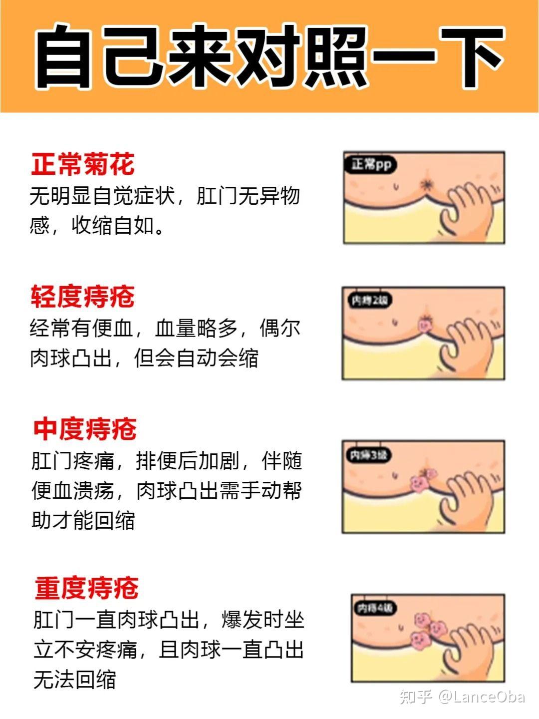 但是得了痔疮越来越严重,一定是这些情况所导致的!