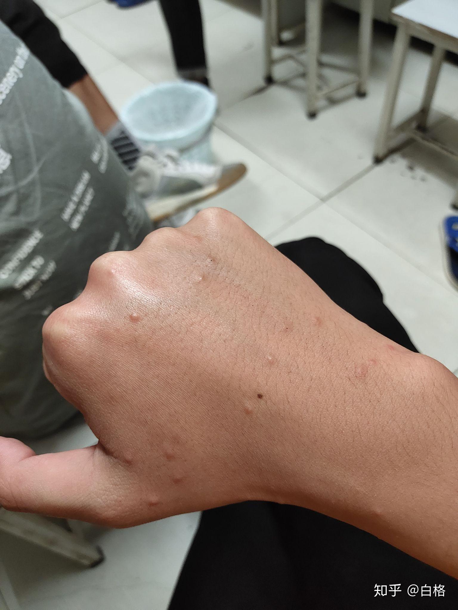 手上起了小包 像蚊子咬的一样? - 知乎