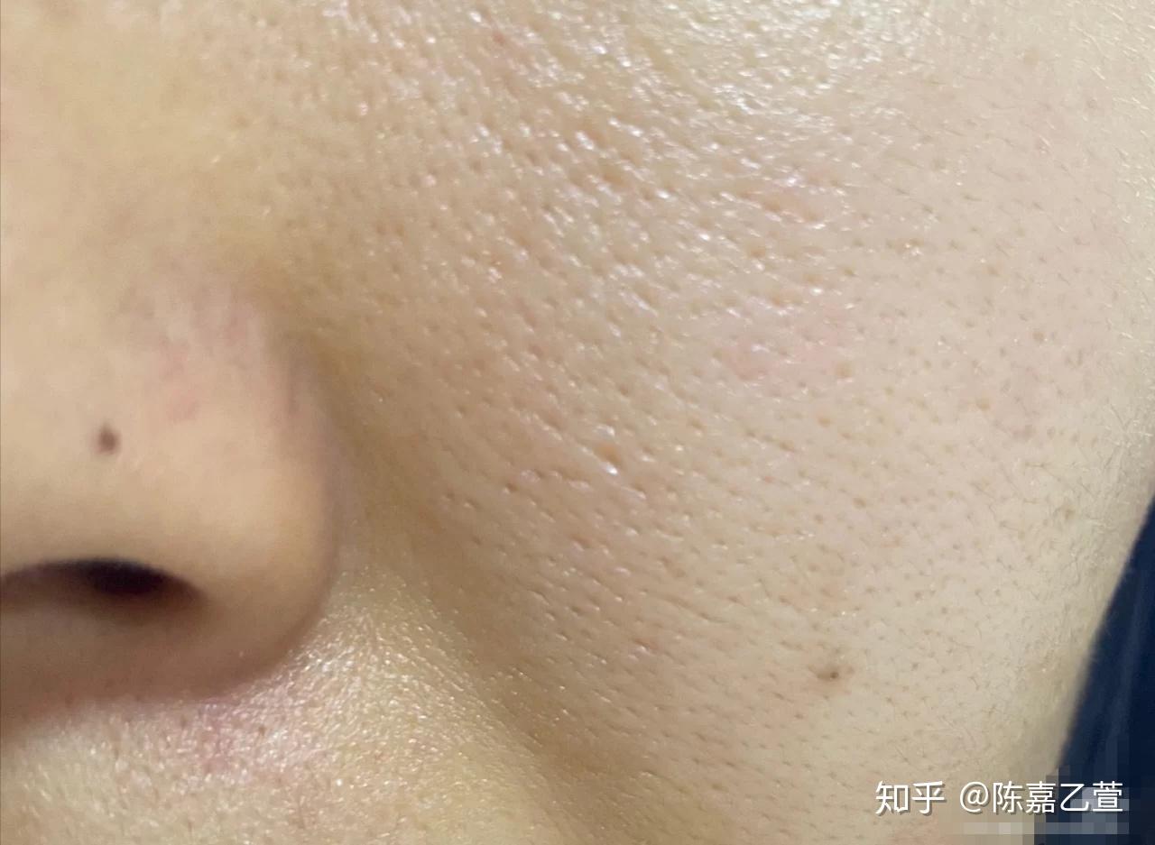 陈嘉乙萱解读毛孔粗大怎么形成的毛孔粗大怎么办怎么解决毛孔粗大问题