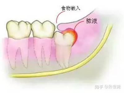 智齿发炎肿痛怎么办 知乎