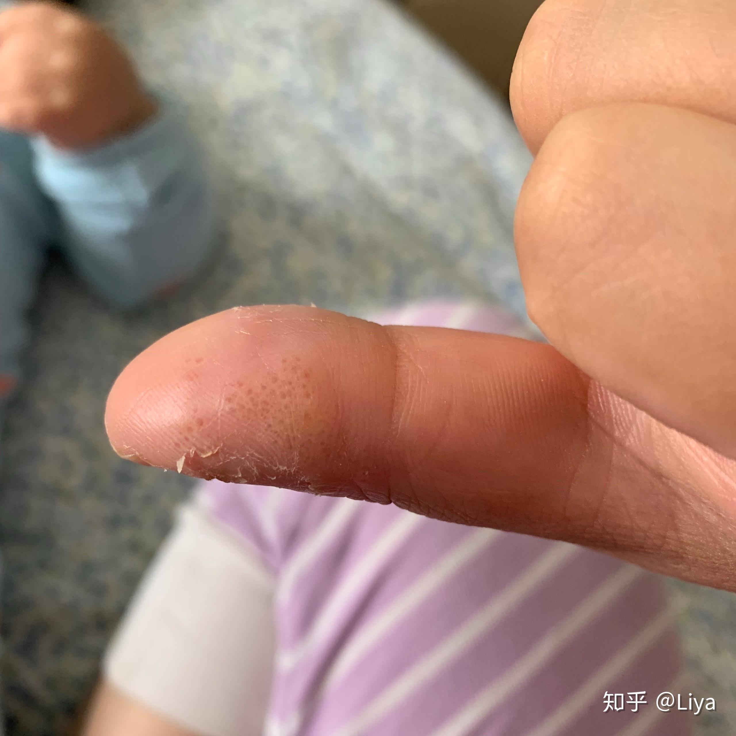 最近手上突然冒出这种皮下小水泡,求助! - 知乎