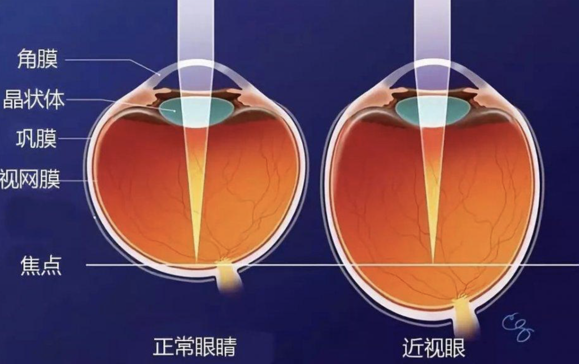 近视手术后遗症群_近视眼手术后遗症_手术近视治疗后遗症